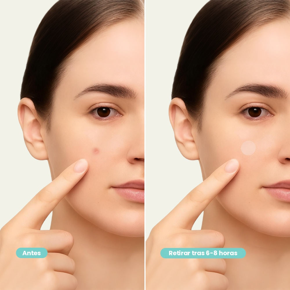 Parches hidrocoloides faciales para acné, ultrafinos y transparentes, 15 unidades